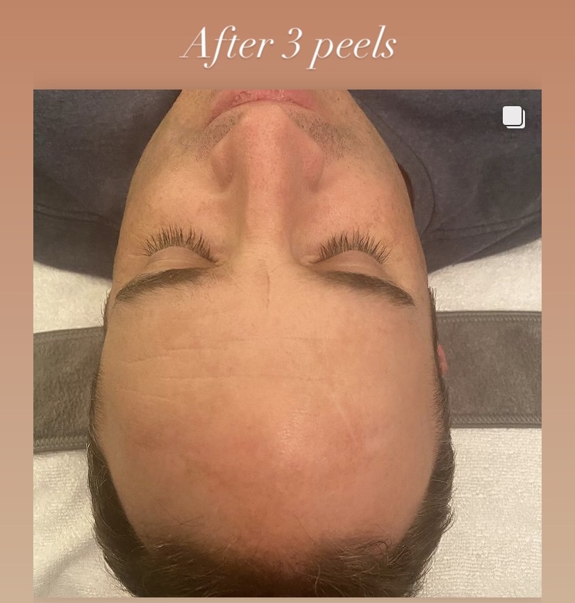 I work off commission at ZenVida Wellness & Aesthetics - Samaná - Skin Cleansing