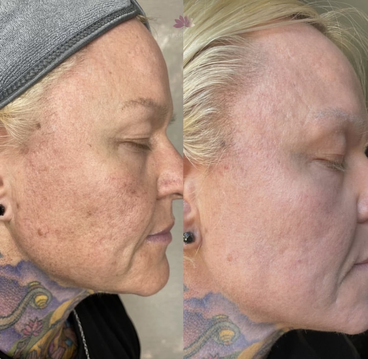 I work off commission at ZenVida Wellness & Aesthetics - Samaná - Skin Cleansing