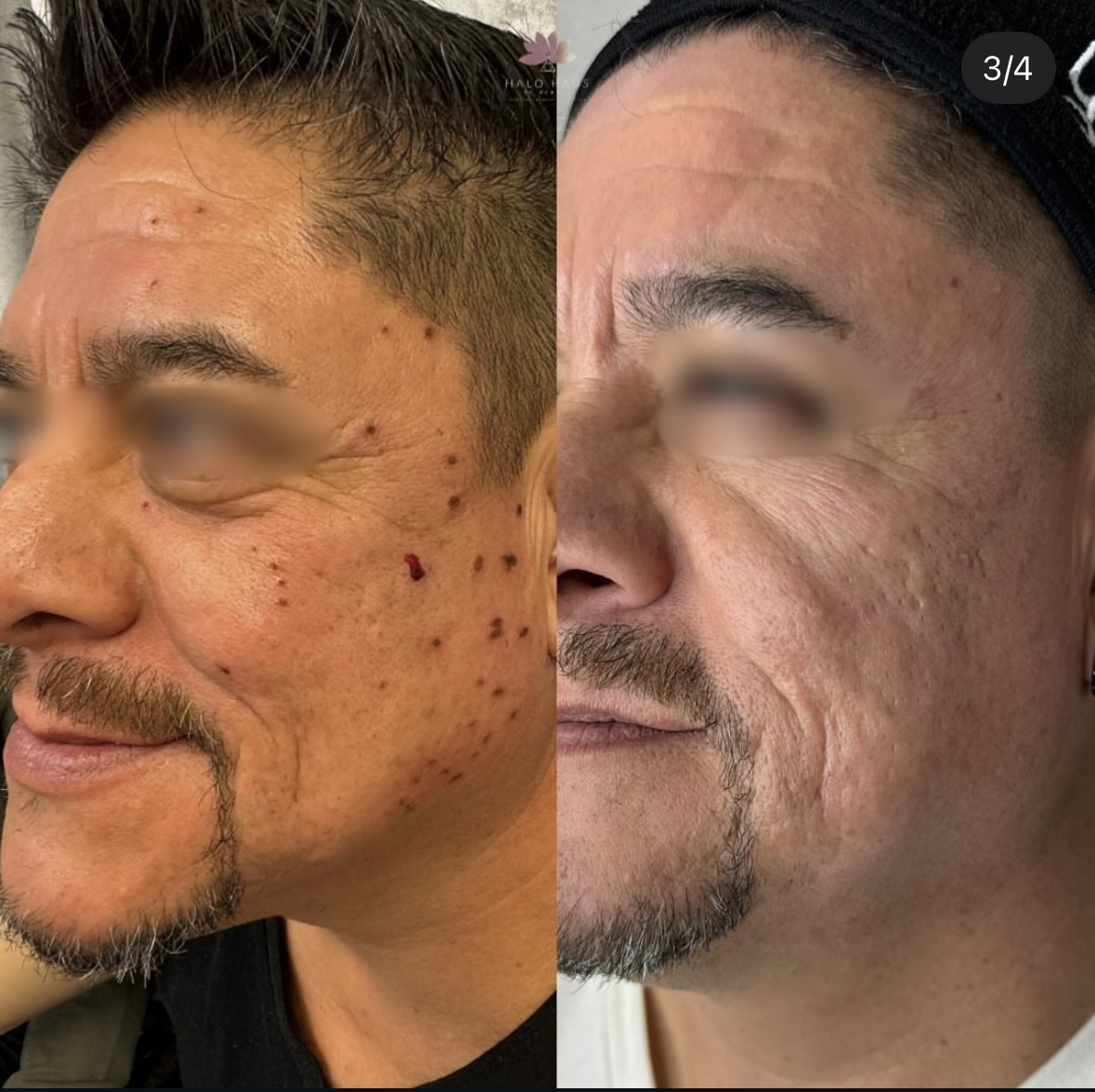 I work off commission at ZenVida Wellness & Aesthetics - Samaná - Skin Cleansing