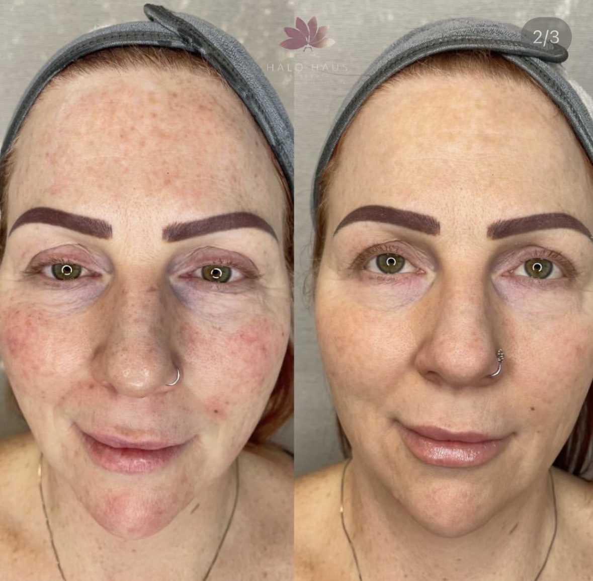 I work off commission at ZenVida Wellness & Aesthetics - Samaná - Skin Cleansing