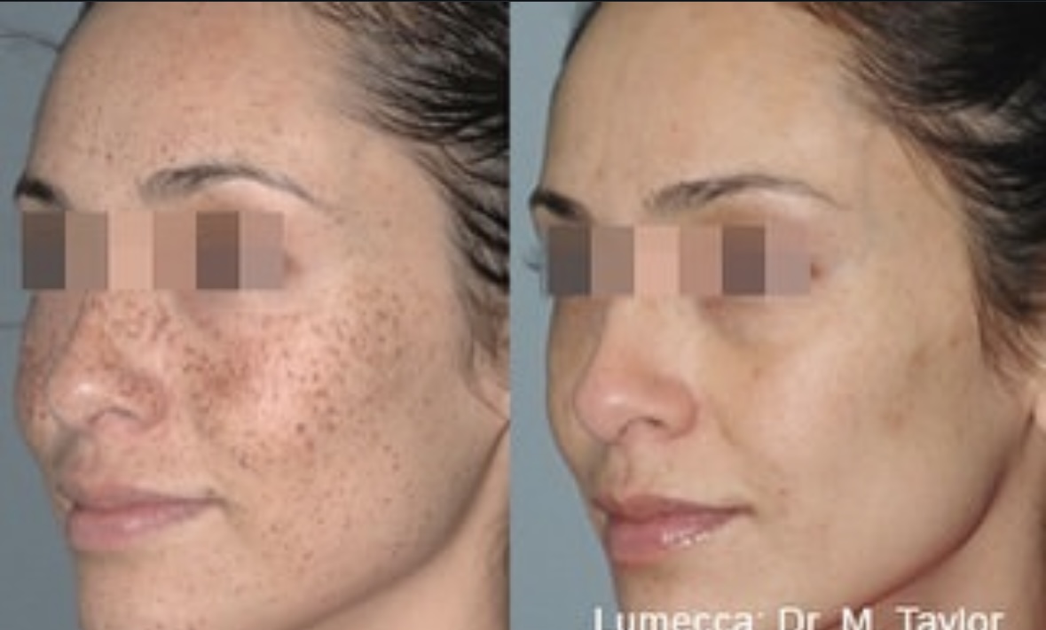 I work off commission at ZenVida Wellness & Aesthetics - Samaná - Skin Cleansing