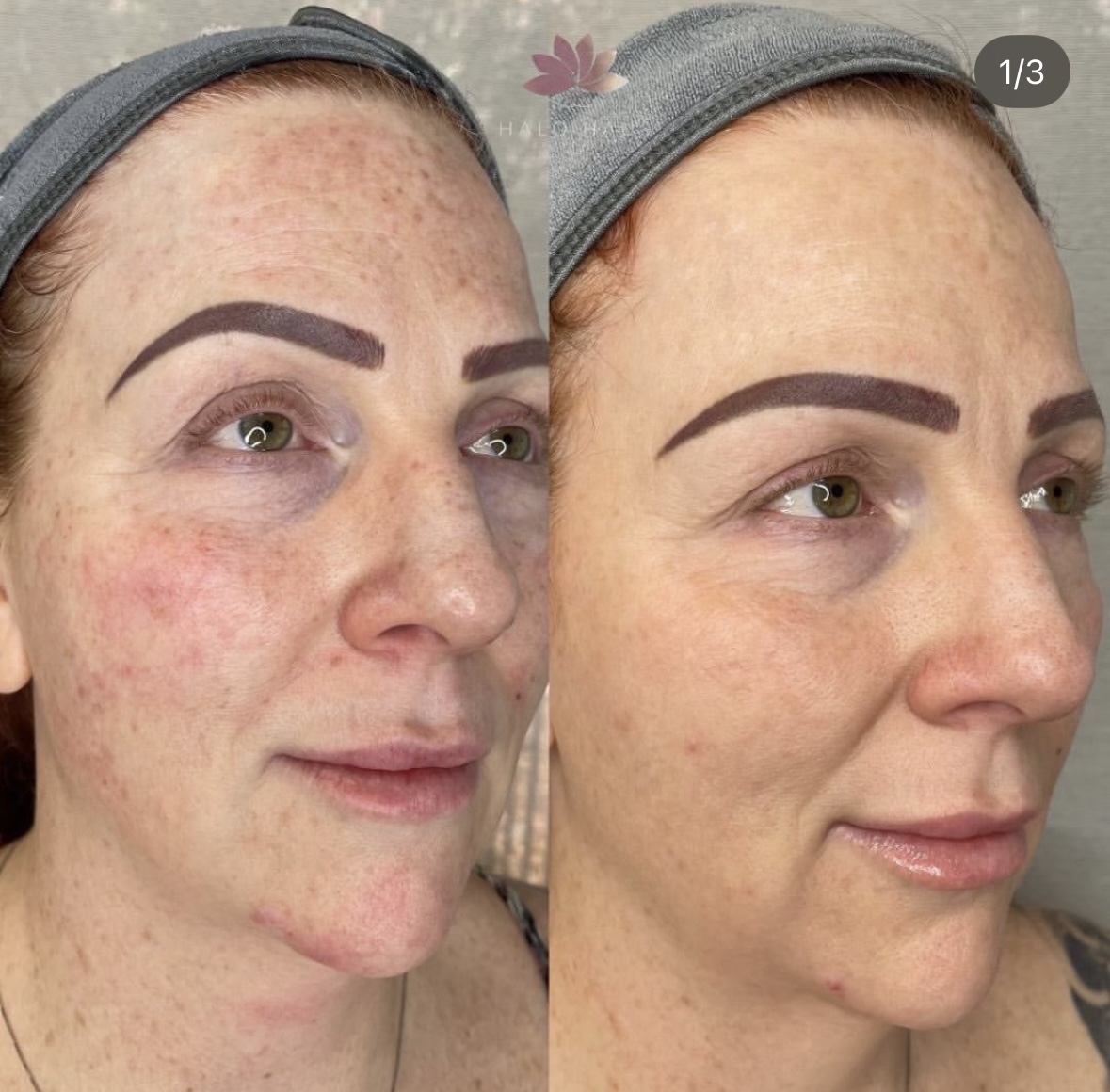 I work off commission at ZenVida Wellness & Aesthetics - Samaná - Skin Cleansing