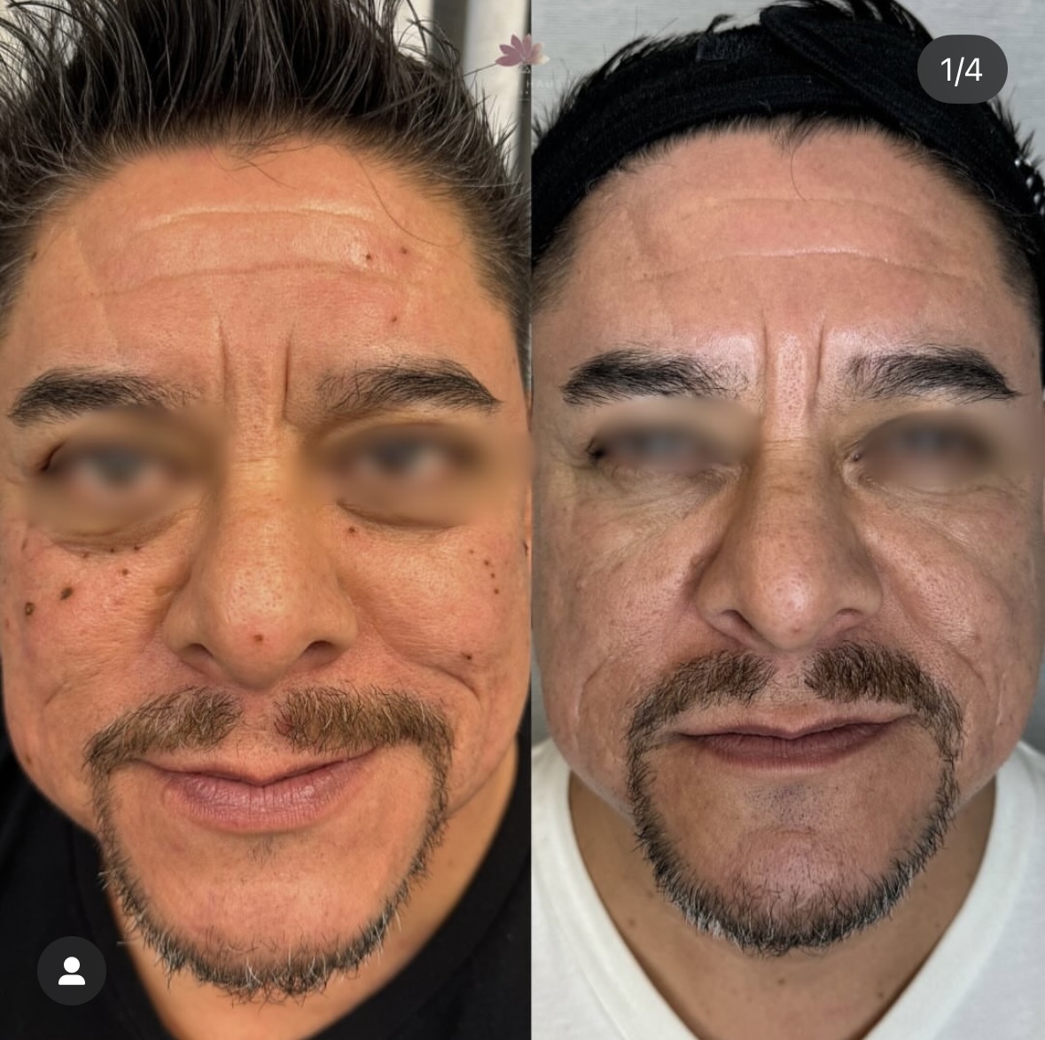 I work off commission at ZenVida Wellness & Aesthetics - Samaná - Skin Cleansing