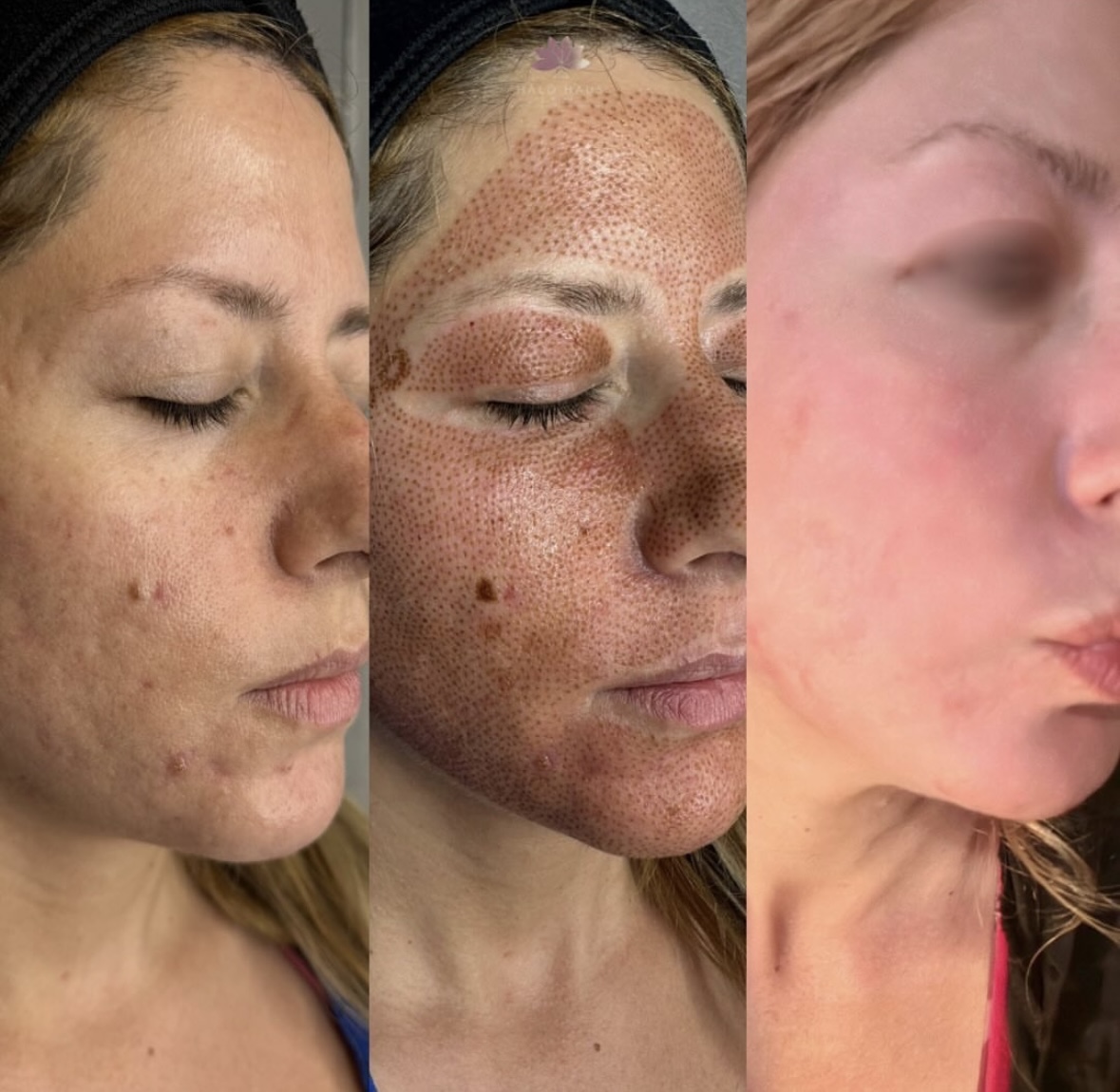 I work off commission at ZenVida Wellness & Aesthetics - Samaná - Skin Cleansing