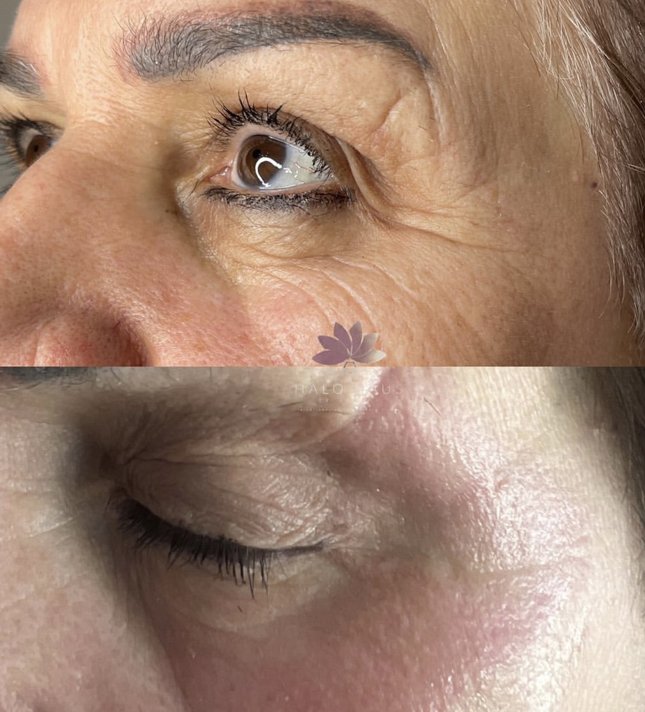 I work off commission at ZenVida Wellness & Aesthetics - Samaná - Skin Cleansing