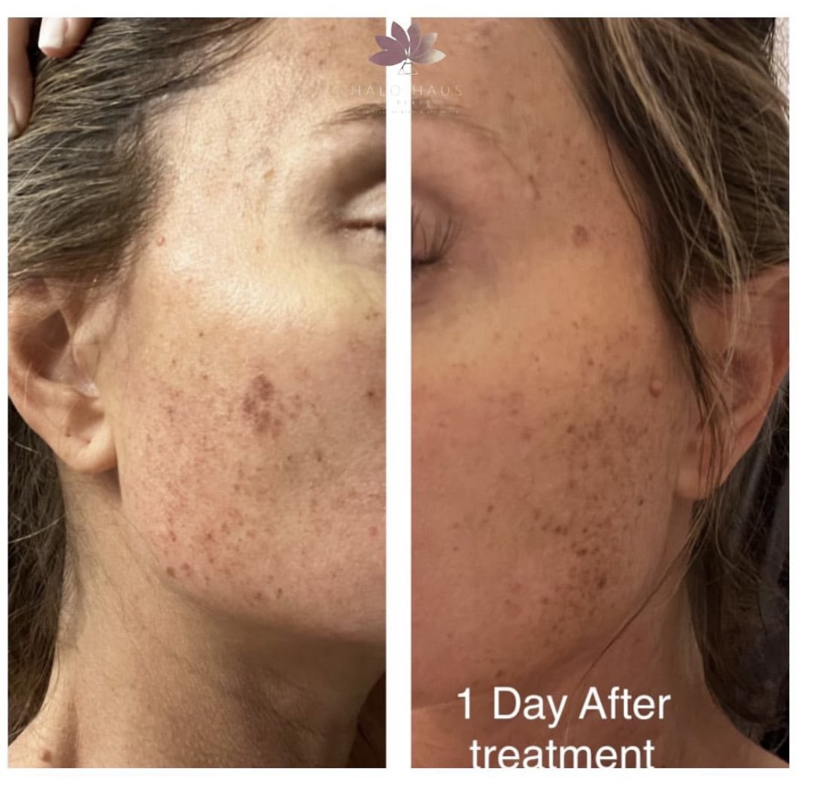 I work off commission at ZenVida Wellness & Aesthetics - Samaná - Skin Cleansing
