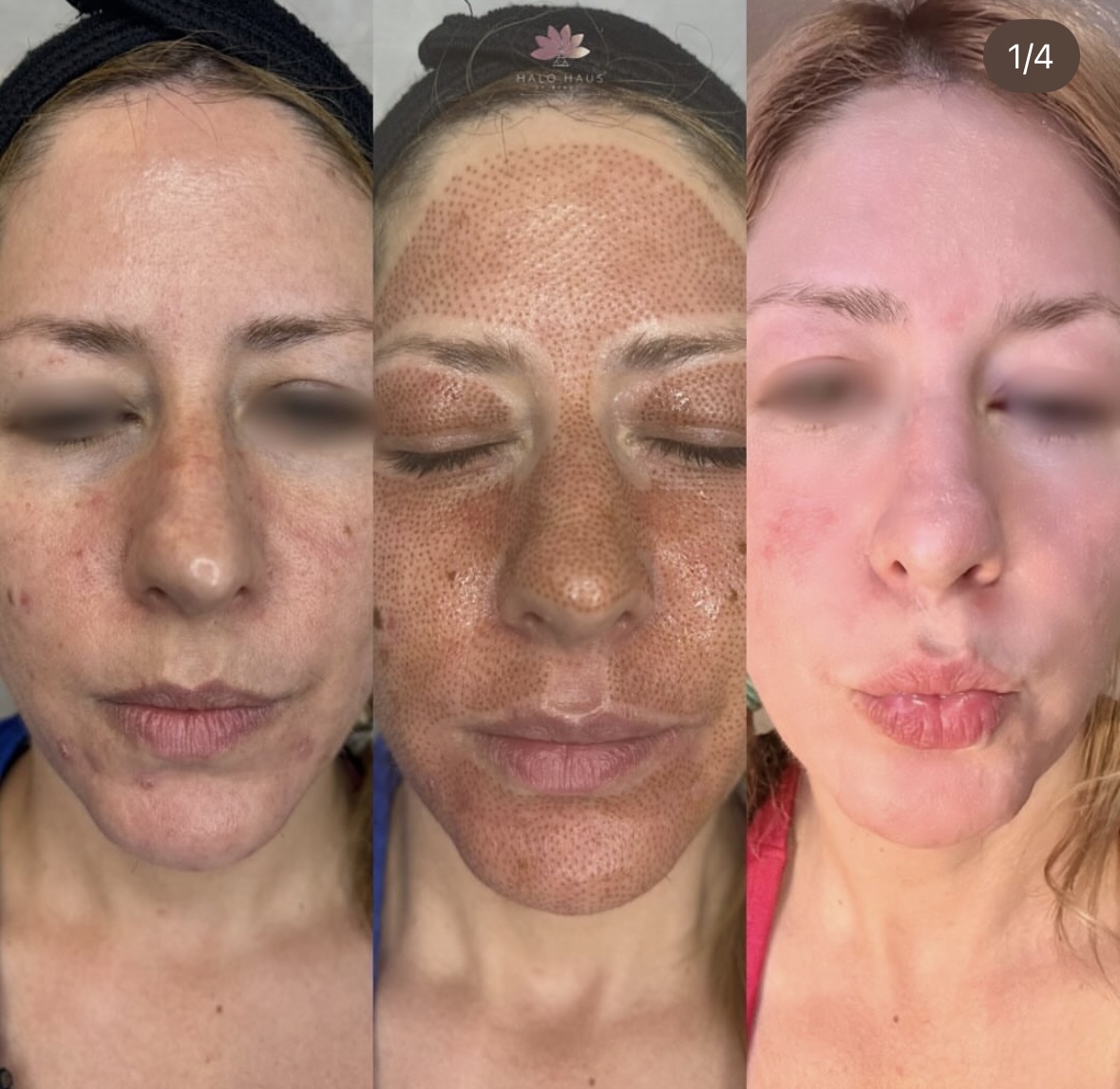 I work off commission at ZenVida Wellness & Aesthetics - Samaná - Skin Cleansing