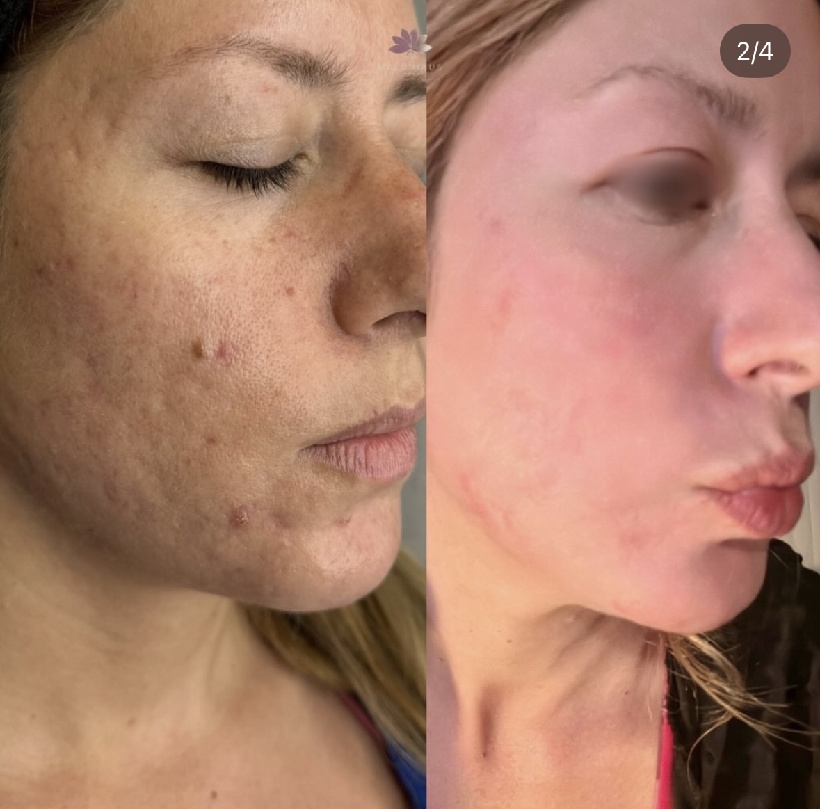 I work off commission at ZenVida Wellness & Aesthetics - Samaná - Beauty services