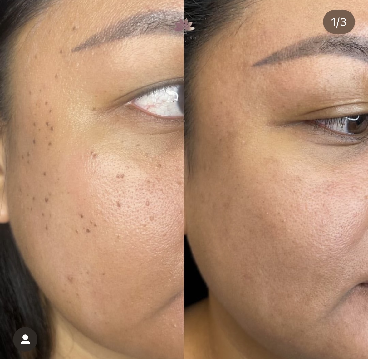 I work off commission at ZenVida Wellness & Aesthetics - Samaná - Skin Cleansing