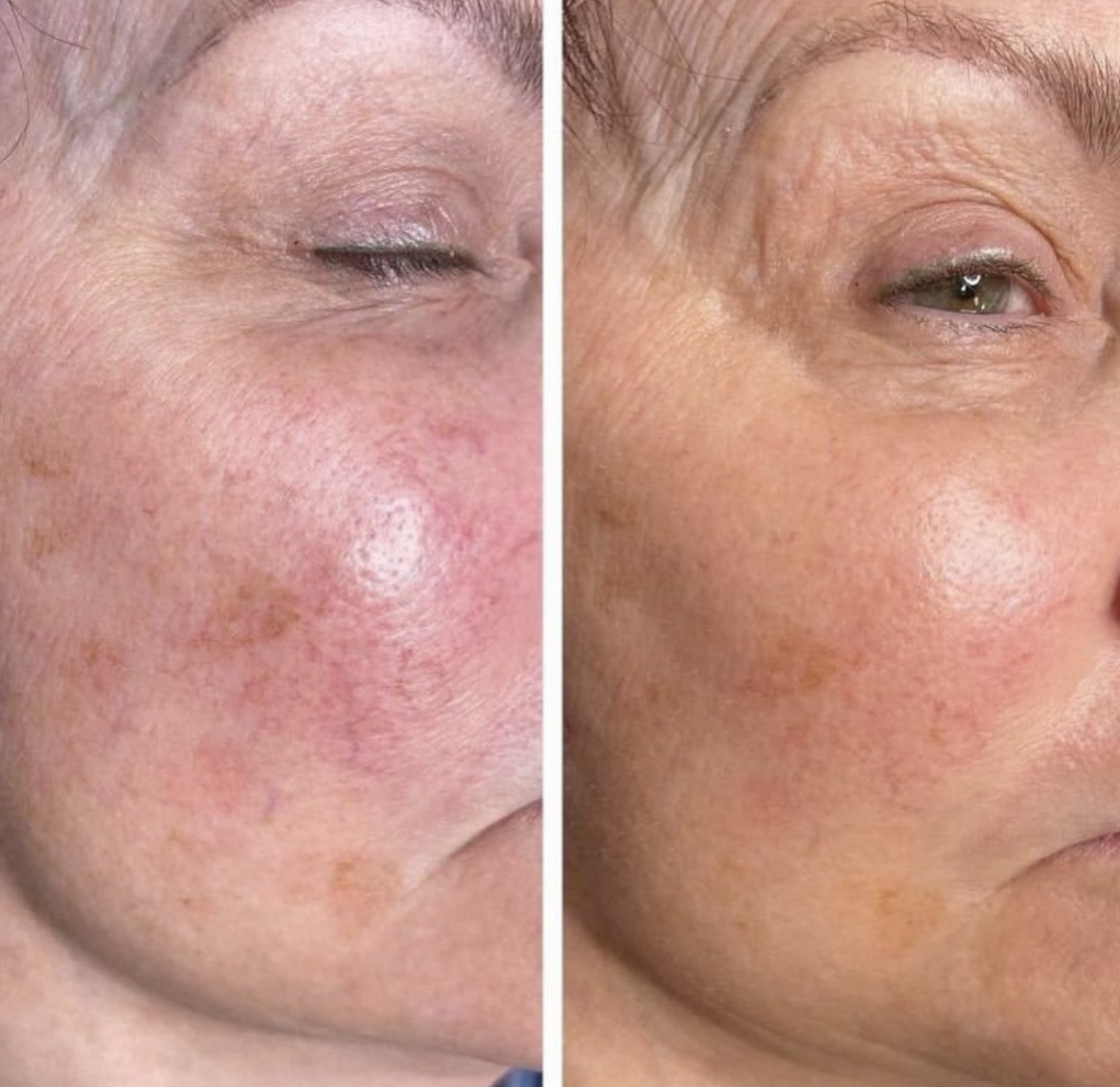 I work off commission at ZenVida Wellness & Aesthetics - Samaná - Skin Cleansing
