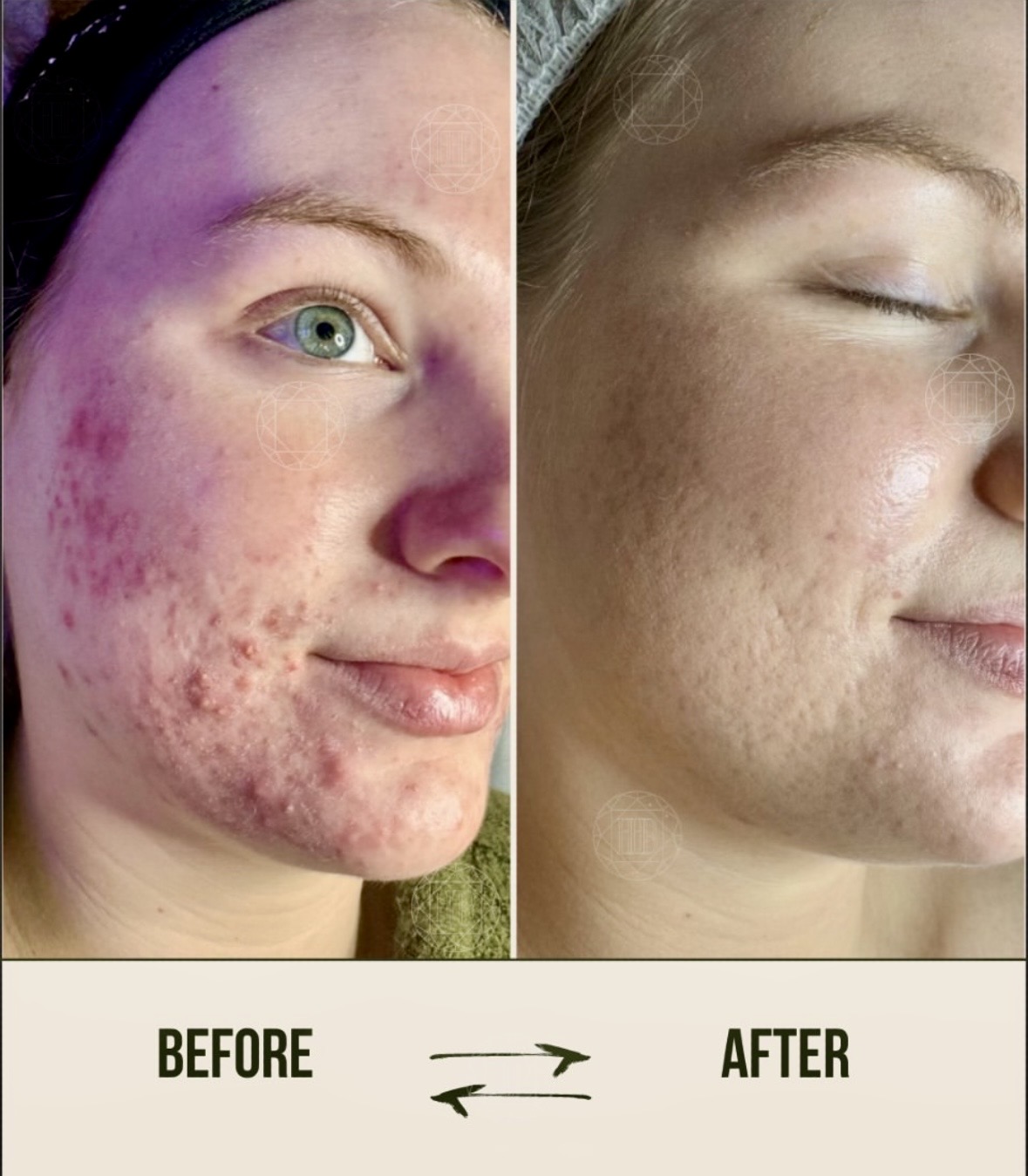 I work off commission at ZenVida Wellness & Aesthetics - Samaná - Skin Cleansing