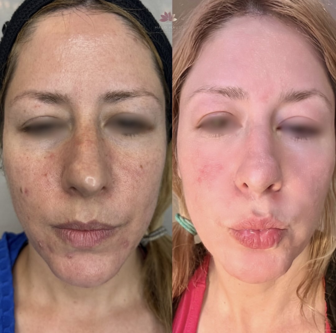 I work off commission at ZenVida Wellness & Aesthetics - Samaná - Beauty services