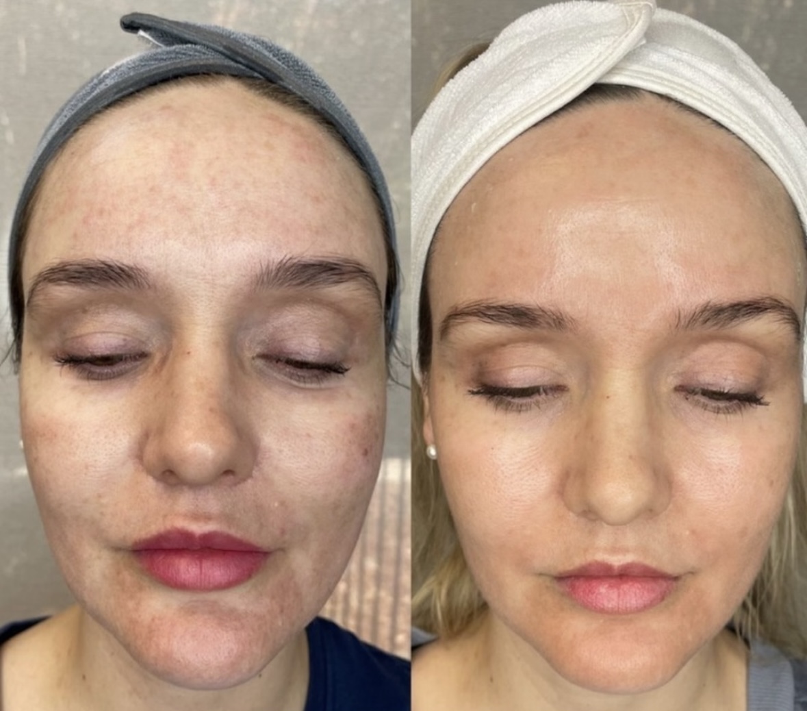 I work off commission at ZenVida Wellness & Aesthetics - Samaná - Skin Cleansing