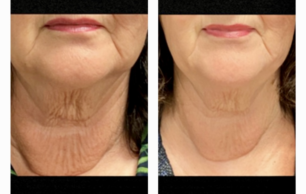 I work off commission at ZenVida Wellness & Aesthetics - Samaná - Skin Cleansing