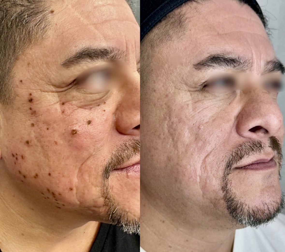 I work off commission at ZenVida Wellness & Aesthetics - Samaná - Skin Cleansing