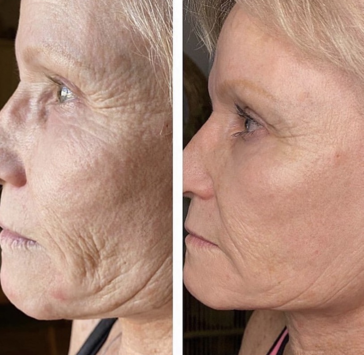 I work off commission at ZenVida Wellness & Aesthetics - Samaná - Skin Cleansing