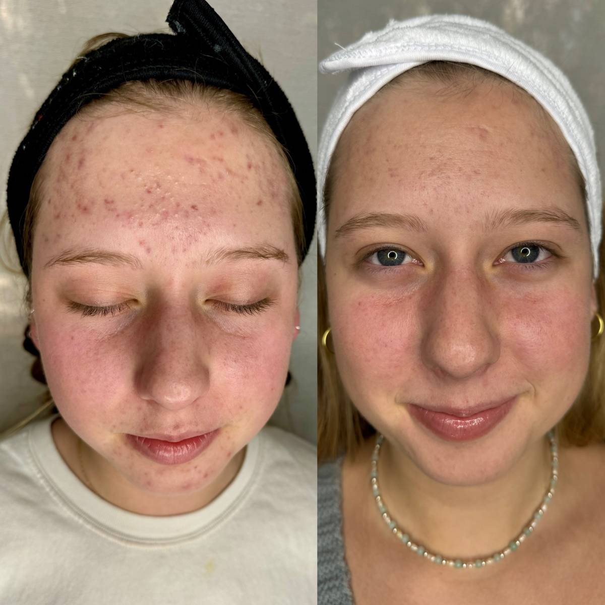 I work off commission at ZenVida Wellness & Aesthetics - Samaná - Skin Cleansing