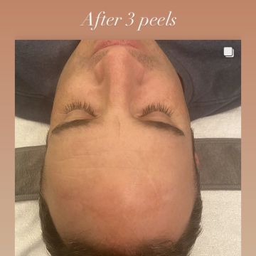 I work off commission at ZenVida Wellness & Aesthetics - Samaná - Skin Cleansing