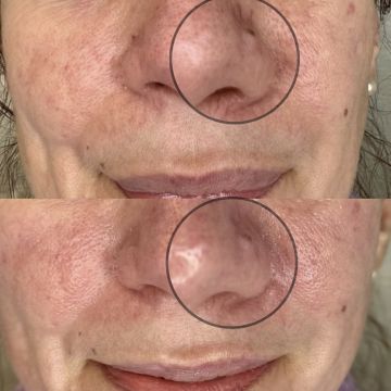 I work off commission at ZenVida Wellness & Aesthetics - Samaná - Skin Cleansing