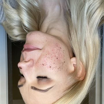 I work off commission at ZenVida Wellness & Aesthetics - Samaná - Skin Cleansing