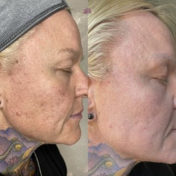 I work off commission at ZenVida Wellness & Aesthetics - Samaná - Skin Cleansing