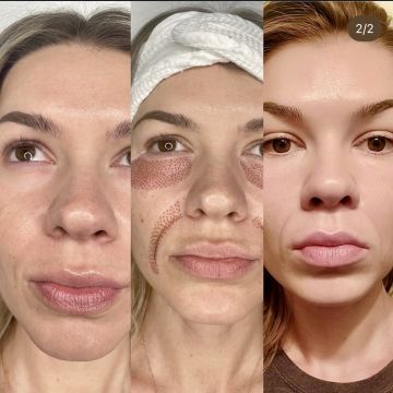 I work off commission at ZenVida Wellness & Aesthetics - Samaná - Skin Cleansing