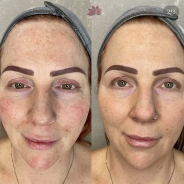 I work off commission at ZenVida Wellness & Aesthetics - Samaná - Skin Cleansing