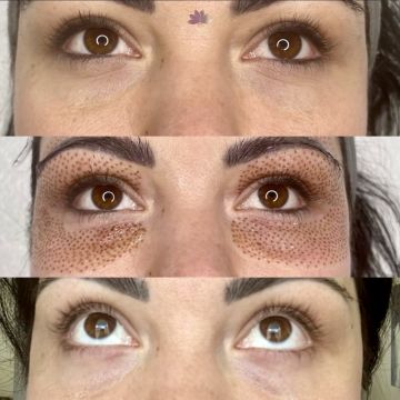 I work off commission at ZenVida Wellness & Aesthetics - Samaná - Skin Cleansing