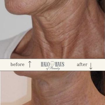 I work off commission at ZenVida Wellness & Aesthetics - Samaná - Skin Cleansing