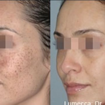 I work off commission at ZenVida Wellness & Aesthetics - Samaná - Skin Cleansing
