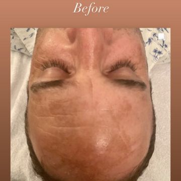 I work off commission at ZenVida Wellness & Aesthetics - Samaná - Skin Cleansing