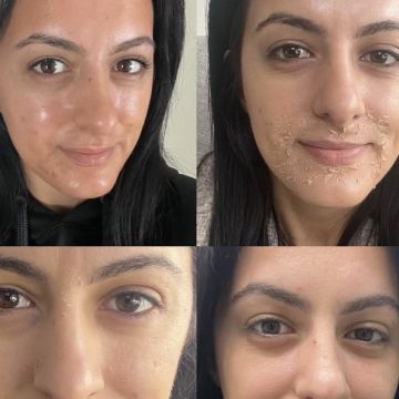 I work off commission at ZenVida Wellness & Aesthetics - Samaná - Skin Cleansing