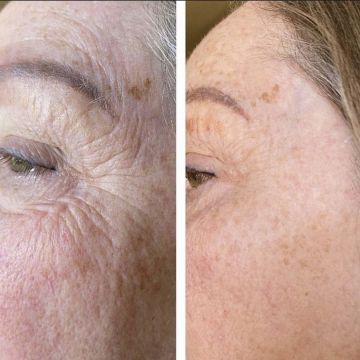 I work off commission at ZenVida Wellness & Aesthetics - Samaná - Skin Cleansing