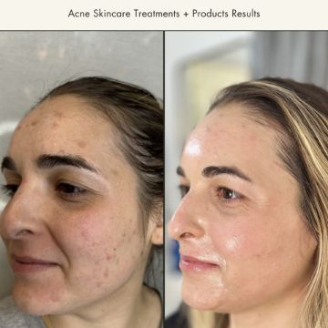 I work off commission at ZenVida Wellness & Aesthetics - Samaná - Skin Cleansing
