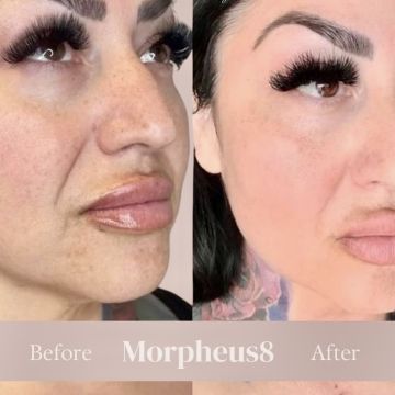 I work off commission at ZenVida Wellness & Aesthetics - Samaná - Skin Cleansing