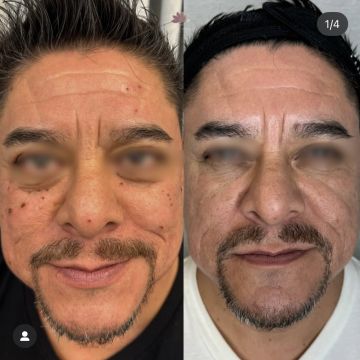 I work off commission at ZenVida Wellness & Aesthetics - Samaná - Skin Cleansing