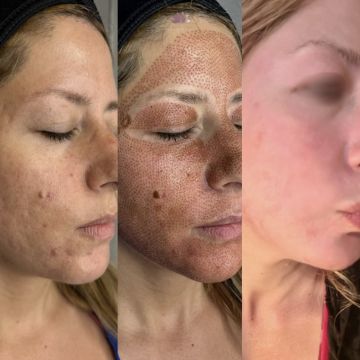 I work off commission at ZenVida Wellness & Aesthetics - Samaná - Skin Cleansing