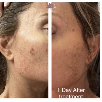 I work off commission at ZenVida Wellness & Aesthetics - Samaná - Skin Cleansing