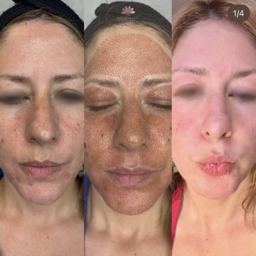 I work off commission at ZenVida Wellness & Aesthetics - Samaná - Skin Cleansing