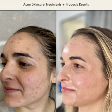 I work off commission at ZenVida Wellness & Aesthetics - Samaná - Skin Cleansing