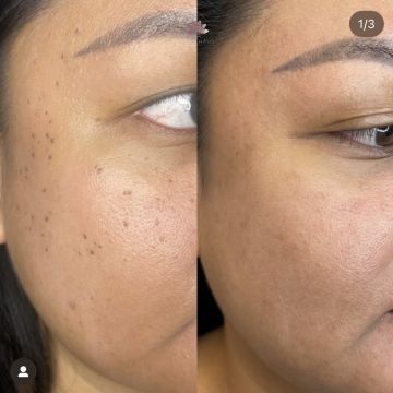 I work off commission at ZenVida Wellness & Aesthetics - Samaná - Skin Cleansing
