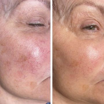 I work off commission at ZenVida Wellness & Aesthetics - Samaná - Skin Cleansing