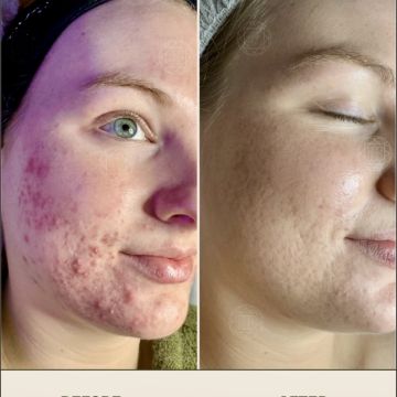 I work off commission at ZenVida Wellness & Aesthetics - Samaná - Skin Cleansing