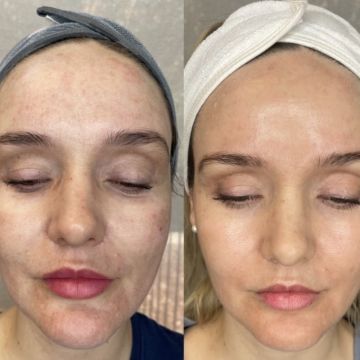 I work off commission at ZenVida Wellness & Aesthetics - Samaná - Skin Cleansing