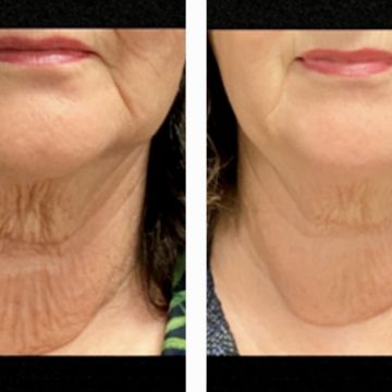 I work off commission at ZenVida Wellness & Aesthetics - Samaná - Skin Cleansing