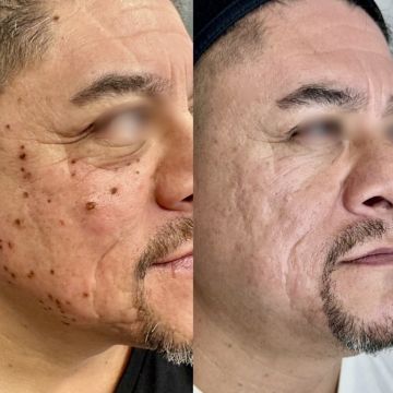 I work off commission at ZenVida Wellness & Aesthetics - Samaná - Skin Cleansing
