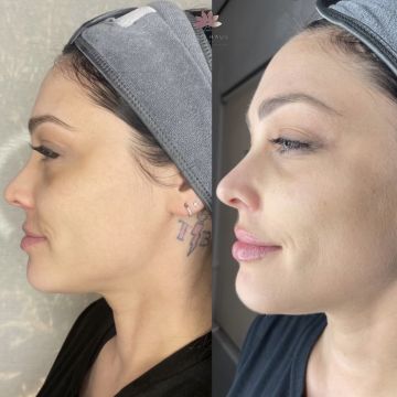 I work off commission at ZenVida Wellness & Aesthetics - Samaná - Skin Cleansing