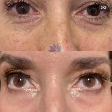 I work off commission at ZenVida Wellness & Aesthetics - Samaná - Skin Cleansing