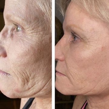 I work off commission at ZenVida Wellness & Aesthetics - Samaná - Skin Cleansing