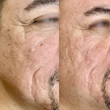 I work off commission at ZenVida Wellness & Aesthetics - Samaná - Skin Cleansing